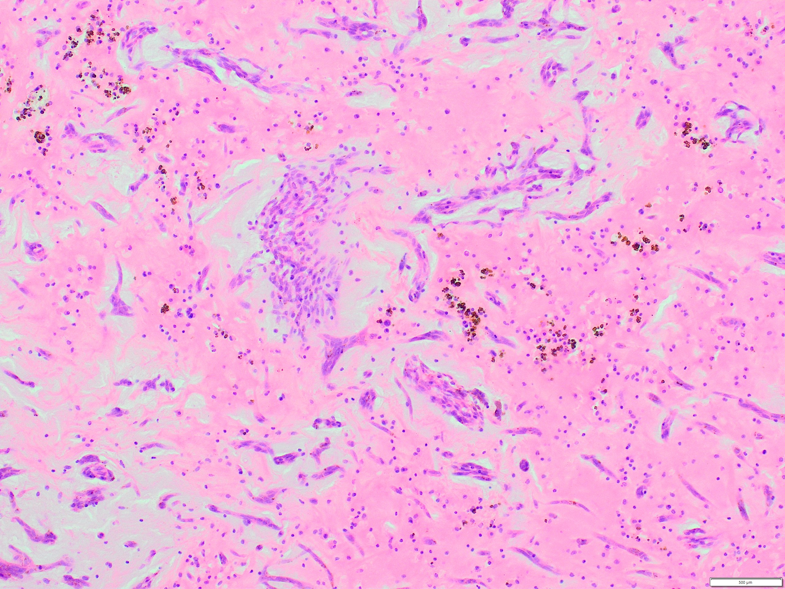 Cardiac myxoma | Katedra Patomorfologii i Medycyny Sądowej School of ...