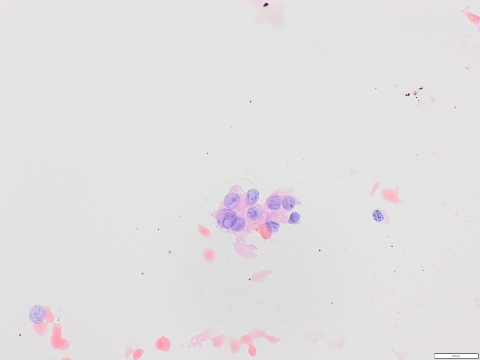 Papillary cyt.