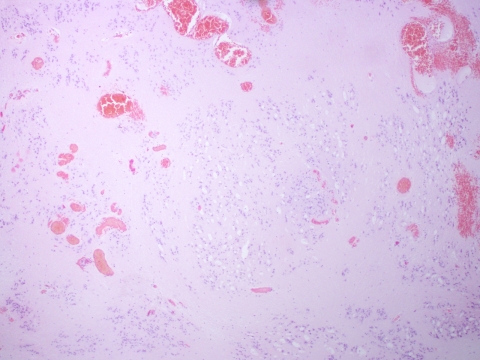 Subependymoma