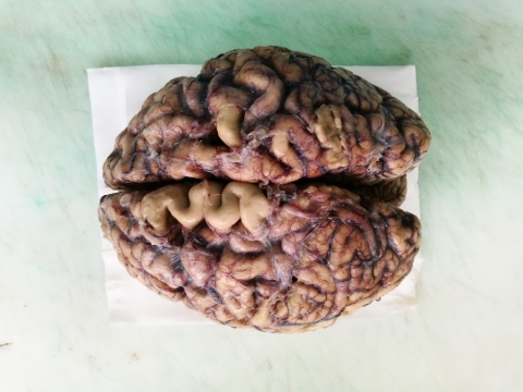 Senile cerebral (brain) atrophy