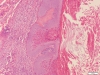 Mięczak zakaźny (molluscum contagiosum)