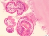 Torbiel bąblowcowa (Echinococcus granulosus)