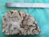 Focus of an infarct of a brain results leaving the cavity