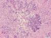 Aspergillus mycelium lung 1