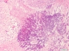 Aspergillus mycelium lung 2