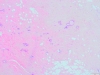 Breast fibrocystic change 2x