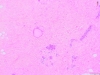 Breast fibrocystic change 5x