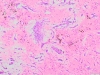 Cardiac myxoma 10x