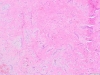 Cardiac myxoma 2x