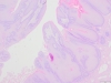 Condyloma 2x