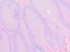 Condyloma 5x