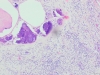 Infective endocarditis 10x