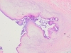 Infective endocarditis 2x