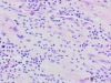 Infective endocarditis 40x