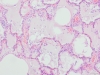 Lung oedema 10x