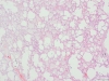 Lung oedema 2x