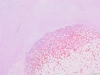 Myelolipoma 2x