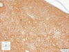 Pozytywna reakcja immunohistochemiczna. Barwienie CD 117.
