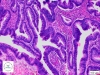 High-grade dysplasia of the colonic epithelium.