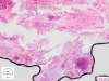 Guz mieszany ślinianki przyusznej. Materiał cytologiczny.