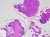Green line – normal squamous epithelium, red line – invasive squamous cell carcinoma.