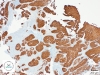 Dodatnia reakcja komórek raka płaskonabłonkowego. Barwienie immunohistochemiczne CK 5/6.