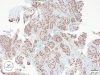 Dodatnia reakcja komórek raka płaskonabłonkowego. Barwienie immunohistochemiczne p63.