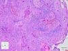 Red arrows – mitotic figures. Green arrows – acute inflammatory infiltrate. Blue arrows – neoplastic cells with high N/C ratio.