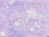 Red circles – neoplastic glands. Green arrows – acute inflammatory infiltrate.
