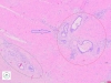 Red and green circles – neoplastic glands. Blue arrow – acute inflammatory infiltrate.