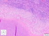 Gruźlica (Mycobacterium tuberculosis). Zapalenie ziarniniakowe z martwicą serowatą.