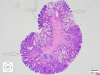 Upper part - epithelial stalk, lower part - colonic adenoma.